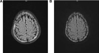 Multiple Myeloma, Misdiagnosed As Somatic Symptom Disorder: A Case Report